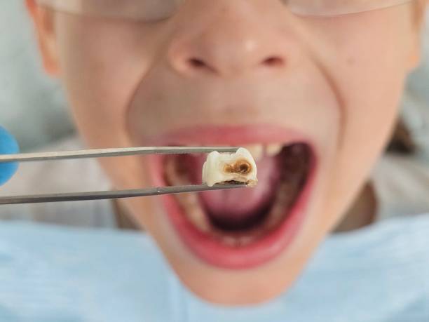 Best Emergency Treatment for Toothache in Roy, UT