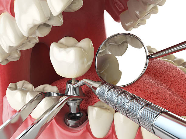 Best Emergency Broken Tooth Repair in Roy, UT